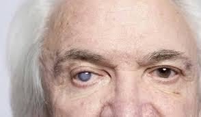 جراحات المياه البيضاء